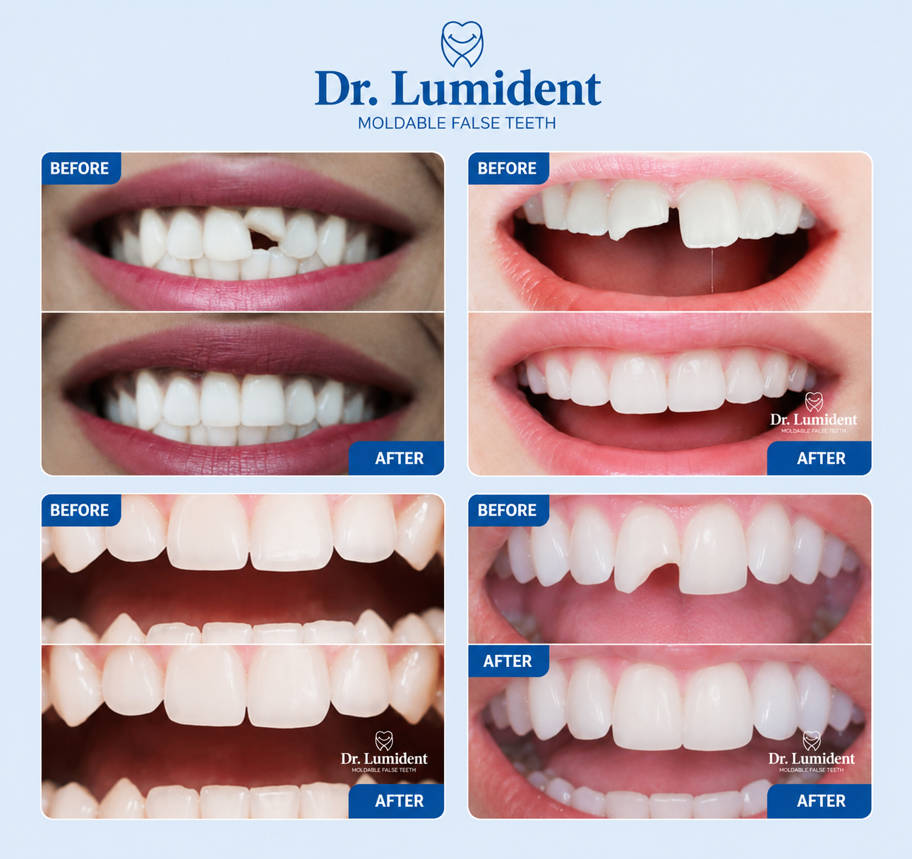 Dr. Lumident Instant Tooth Repair Kit